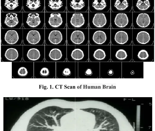 Fig. 1. CT ScanCT Scan of Human Brain  