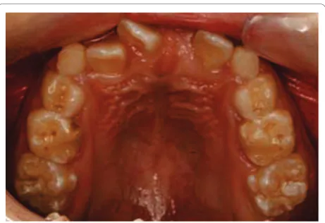 Figure 2 Intra-oral upper occlusal view showing the severecrowding.