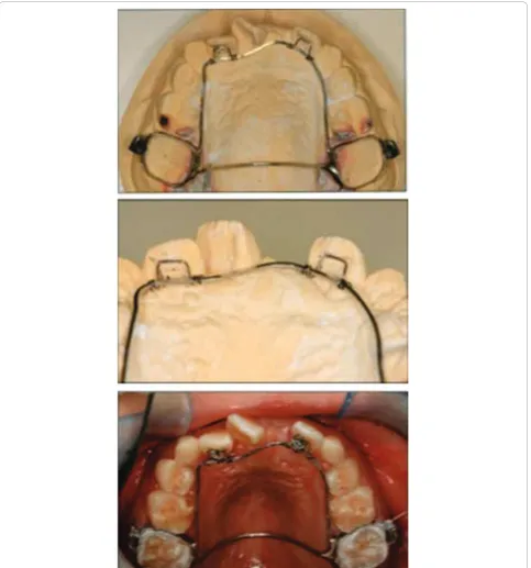 Figure 7 Upper fixed palatal appliance with torquing spring used with our patient. Top: the appliance was constructed from two molarband connected by palatal arch