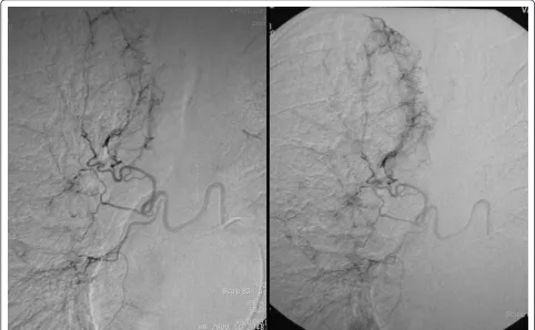 Figure 1 Selective catheterization of a hypertrophic right bronchial artery in a 56-year-old man with two episodes of severehemoptysis
