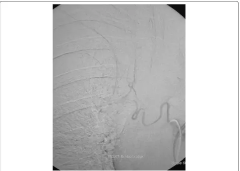 Figure 2 Elimination of pathologic hypervascularity after embolization with tris-acryl gelatin microspheres (500-700through the cobra catheter μm) injected.