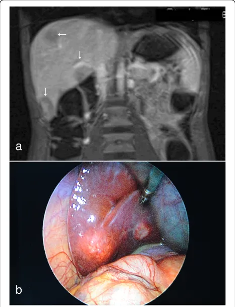 Fig. 1 Axial, T2-weighted, half-Fourier single-shot turbo spin-echo hydromagnetic resonance imaging scan of the patient’s abdomen