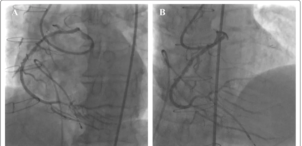 Fig. 3 Final angiography demonstrated favorable dilatation from the mid right coronary artery through to proximal atrioventricular branch