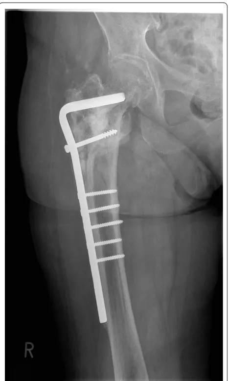 Figure 7 Reamer/Irrigator/Aspirator aspirate