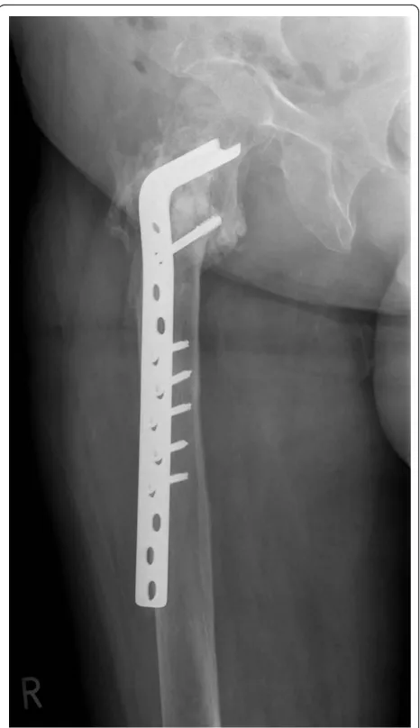 Figure 9 Lateral radiograph demonstrating the 90° CBPrestoring the proper shaft-neck hip angle and union of thefracture site at 10 months following revision surgery with nosigns of avascular necrosis of the femoral head.