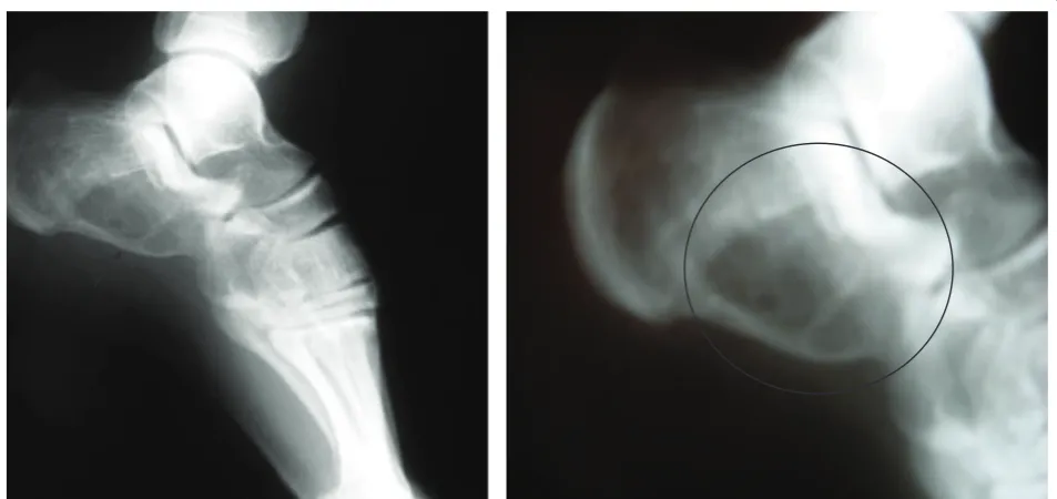 Figure 1 Radiograph showing an expansive but well-marginated osteolytic lesion in the front portion of the patient’s left heel.