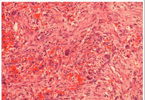 Figure 4 Fibrous septa with spindle cells (small arrow) and multinucleated giant cells (large arrow)
