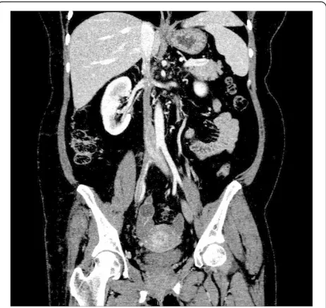 Figure 9 Computed tomography scan below the level of thekidneys showing a filling defect in the inferior vena cava.