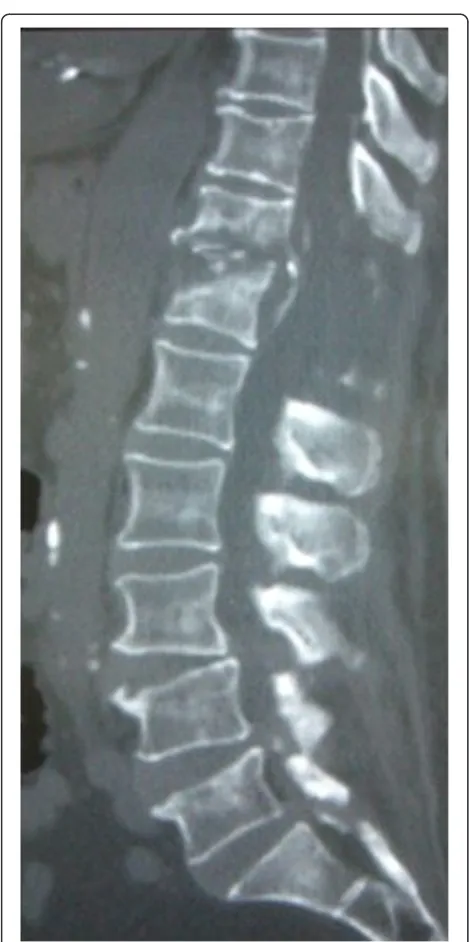 Figure 4 Plain radiograph at 18 months after operation. Completeunion between the T11 and T12 vertebral bodies is seen
