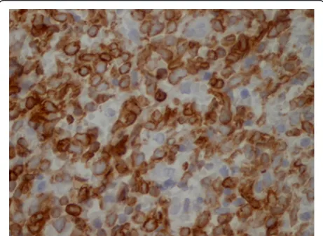 Figure 5 Ki-67stain, 80%, × 20)+ expressed a high proliferation index (Ki-67.