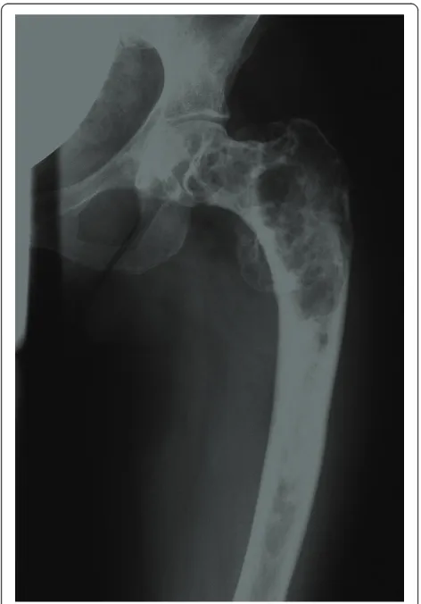 Figure 2 X-ray of the left tibia. Anteroposterior plain film of theleft tibia showing fibrous dysplasia.