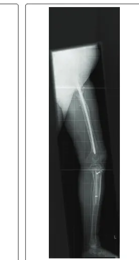 Figure 5 Anteroposterior X-ray of the whole left leg. Situationafter fibrous dysplasia excision of the left proximal femur and lefttibia with correctional osteotomy of the left hip and fixation with aproximal femoral nail, as well as allograft fixation with AO screws ofthe tibia.