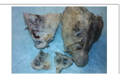 Figure 1 CT of thorax. It shows a round cystic tumor, with significant calcification in the right anterior mediastinum.