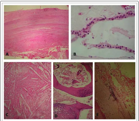 Figure 3 Photomicrograph. The fibrous-wall cysts (A), lined partially by small cuboidal cells (B), containing large areas of cholesterol (C),calcification (D) and small foci of lymphoid tissue (E) (hematoxylin-eosin stain ×10).