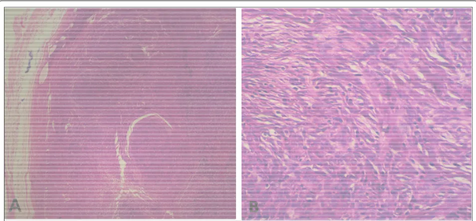 Figure 4 Photomicrograph. An AB thymoma arising in the wall of the cyst (A) (hematoxylin-eosin stain ×10), composed of spindle to oval cellswith lymphocyte rich areas (B) (hematoxylin-eosin stain ×40).