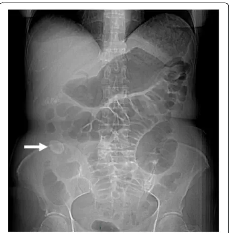 Figure 4 Stones in the small bowel above the anastomosis.