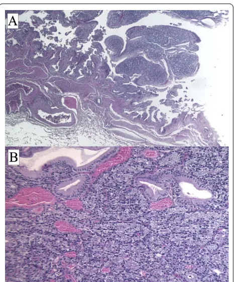 Figure 3 Tumor cells did not express cytokeratin (A), vimentin(B), CD-31 (C), or CD-34 (D), as revealed byimmunohistochemistry