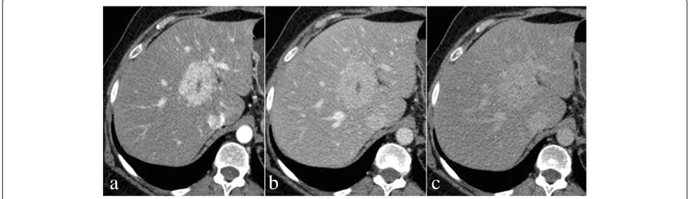 Figure 1 Triphasic 64-detector row computed tomography findings of focal nodular hyperplasia in a 53-year-old woman.computed tomography scan during the portal venous phase shows lesion exhibiting rapid contrast material washout being slightly hypo-attenuatedcompared with surrounding liverenhancement of central scar Arterial phasecontrast-enhanced computed tomography scan shows intense homogeneous enhancement with hypodense focal central scar (a); contrast-enhanced (b); delayed phase contrast-enhanced computed tomography scan shows lesion as isodense and persistent (c).