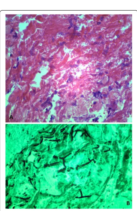 Figure 1 A 3cm necrotic ulcer with an adherent blood clot inthe transverse colon.