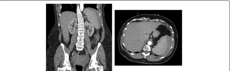 Figure 1 Computed tomography images of atraumatic splenic rupture. Representative sagittal (left) and axial (right) computed tomographyimages of the patient’s abdomen taken on the day she presented to the hospital