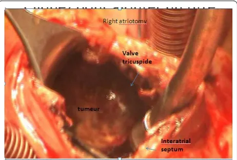 Figure 5 Macroscopic aspect of the tumor. The tumor isinfiltrating the right atrium, the atrioventricular septum and theproximal side of the right ventricle.
