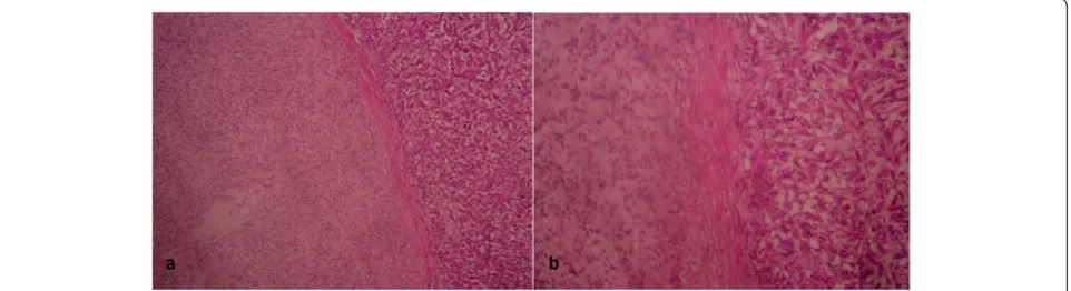 Figure 5 Features of myoepithelioma on histological examination (hematoxylin and eosin staining)