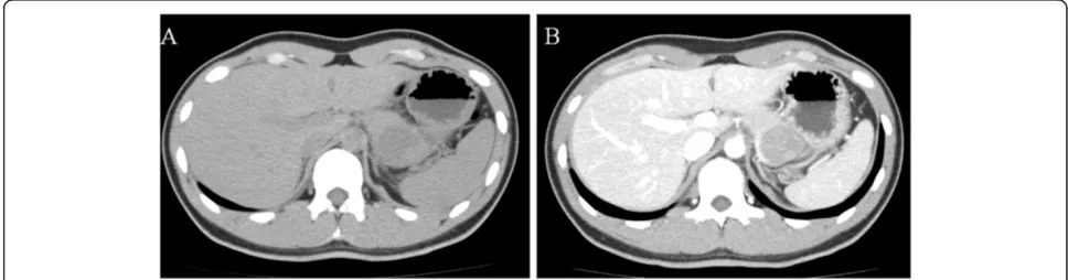 Figure 1 Abdominal computed tomography showing the solid pseudopapillary neoplasm in our patient