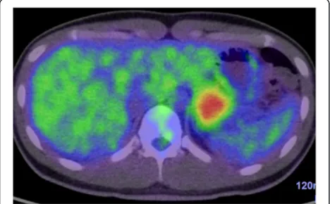 Figure 2 Endoscopic ultrasound. These two images show a low echoic mass of 35mm diameter in the pancreatic tail