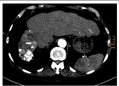 Figure 1 Baseline CT abdomen scan. Early arterial examinationtime, showing liver cirrhosis after transarterial chemoembolizationwith hypotrophy of his right liver lobe and hypertrophy of his leftliver lobe