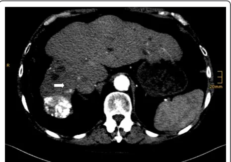 Figure 2 Control CT abdomen scan after eight weeks of AMTtreatment. Early arterial examination time, showing liver cirrhosisafter transarterial chemoembolization