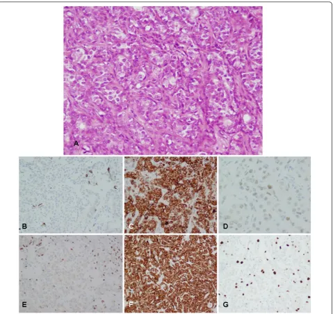Figure 5 Histological and immunohistochemical evaluation of the deep area (group 3)(100× magnification).p63 was only detected in a few myoepithelial cells (100× magnification).