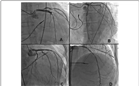 Figure 3 Anteroposterior (AP, Panel A) and left anterior oblique (LAO, Panel B) fluoroscopic projections showing leads position afterCRT.