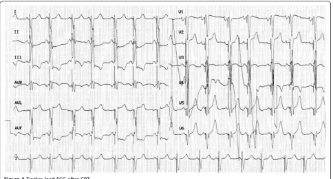 Figure 4 Twelve lead ECG after CRT.