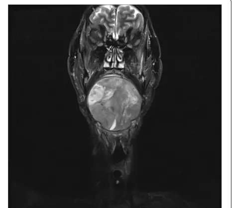 Figure 1 A preoperative magnetic resonance imaging scan inAugust 2011. The entire floor of the mouth, including the tongue,is filled by the tumor.