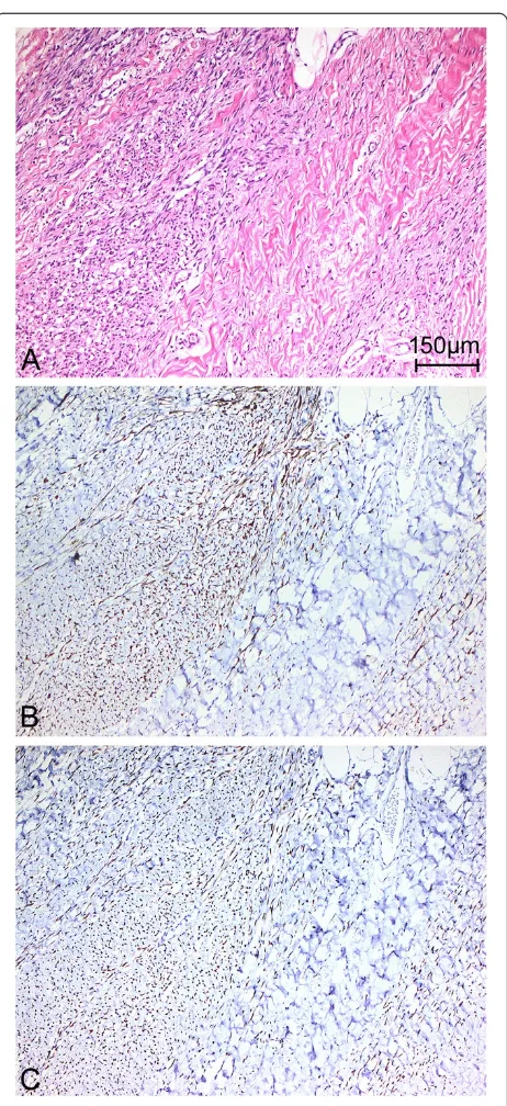 Figure 4 Distinctive morphology of the spindle cellrhabdomyosarcoma, as indicated by (A) hematoxylin and eosinstaining and immunohistochemical staining for (B) desmin and(C) myogenic differentiation 1 (original magnification x 100).
