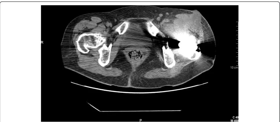 Figure 1 A computed tomography scan image of hip arthroplasty. Evidence of a periprosthetic abscess with diffusion to the left psoasmuscle and cutaneous fistula is shown.
