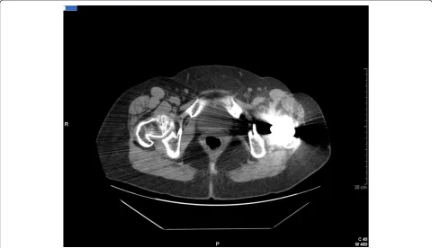 Figure 2 An image of a computed tomography scan performed 12 months after treatment. Regression of the iliopsoas abscess is shown.The cutaneous fistula is completely healed.