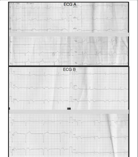 Figure 1 ECG findings. (A) Electrocardiogram on admission. ST-segment elevation in DIII, aVF and ST- segment depression in DI, aVL