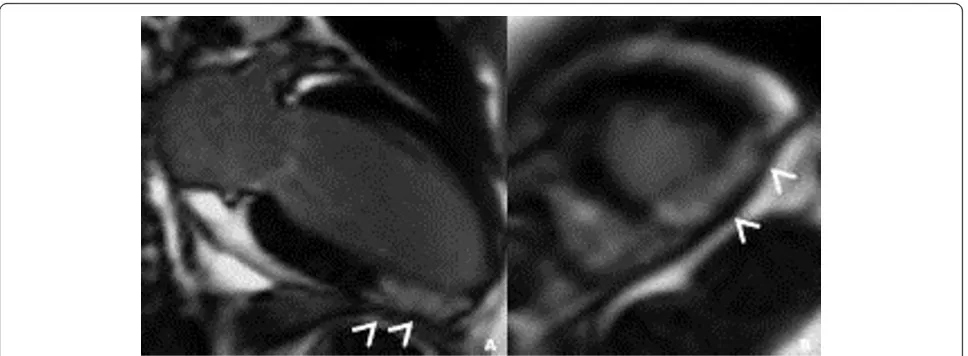 Figure 2 Contrast-enhanced inversion-recovery magnetic resonance study on (A) long axis and (B) short-axis images during thesubacute phase (day five)