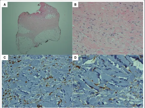 Figure 3 (A) Lower dermis and subcutaneous fat with widened and thickened fibrous septae and increased dermal fibroblasticproliferation with thickened collagen; (B) increased dermal fibroblastic proliferation with thickened collagen fibers; (C, D)immunohistochemistry stains of dermal fibroblastic cells are positive for factor 13a (C) and CD34 (D).