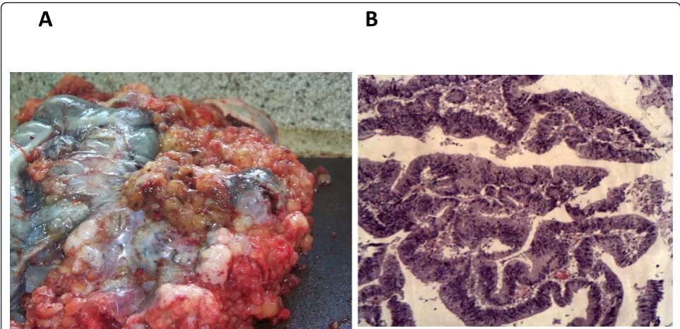 Figure 3 (A) At autopsy, mucinous gelatinous polypoid masses arising from the sigmoid colon and covering the serosa are seen