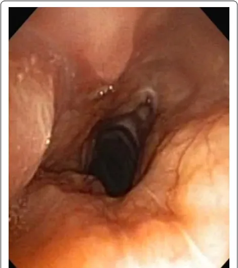 Figure 1 Tracheal computed tomography. A circumferential tracheal tumor caused a reduction of her caliber.
