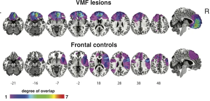 Figure 4-1. Overlap images of the VMF and frontal control lesion groups. Numbers 