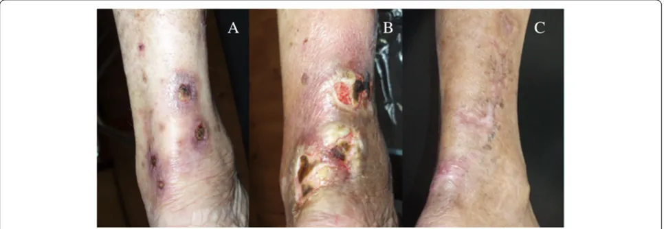 Figure 1 Photographs of calciphylaxis lesions on the left calf. (A) Six weeks after onset, the lesions became ulcerative, exhibiting surfaceeschars