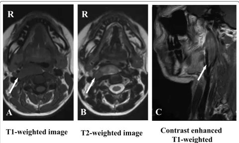 Figure 1 MRI performed before surgical resection. (A) MRI showing that the tumor has low-signal intensity on T1-weighted images.(B) Heterogeneous high-signal intensity on T2-weighted images