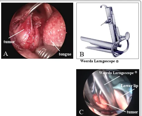 Figure 2 Excision performed via the transoral approach with a novel use of the Weerda laryngoscope