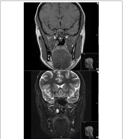 Figure 1 Magnetic resonance images of sinuses demonstrate a fungal infection. Coronal T1-weighted (above) and T2-weighted (below)images demonstrate enlargement of the left sphenoid sinus