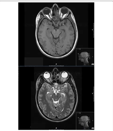 Figure 2 Magnetic resonance images of sinuses demonstrate a recurrence of the fungal infection