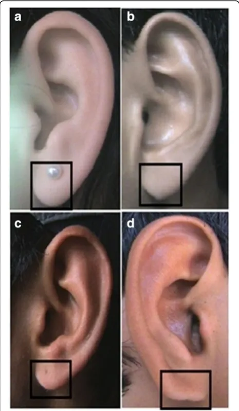 Fig. 4 Photographs showing the different shapes of the earlobe. aTongue. b Triangular