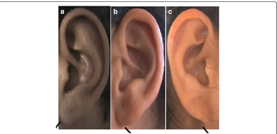 Fig. 5 Photographs showing the different forms of the earlobe attachment. a Free. b Partially attached